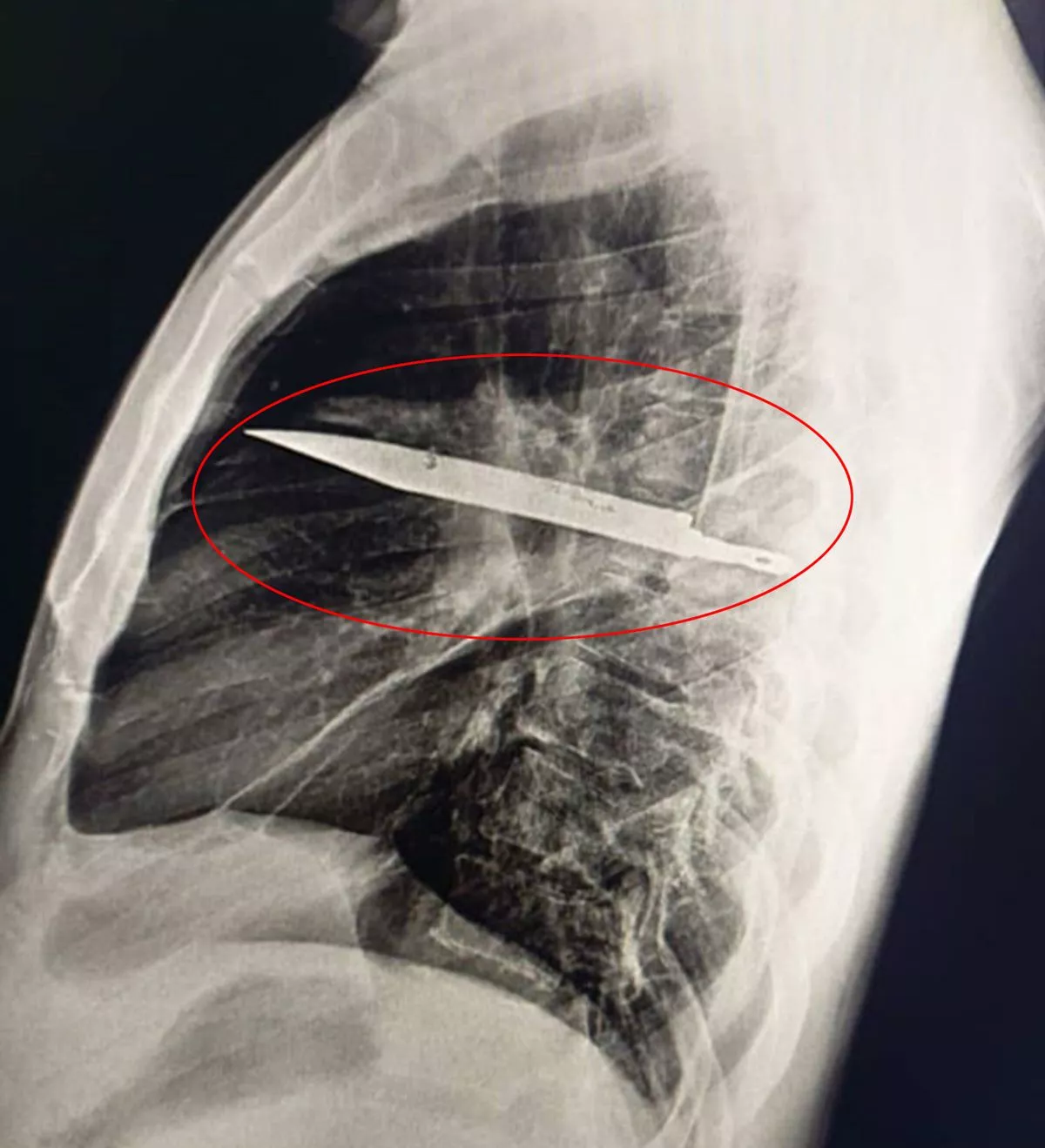 Les médecins découvrent un grand cou.teau logé dans la poitrine d'un homme depuis huit ans