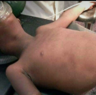 Oh my! See what traditional bonesetters did to a child (graphic photo)