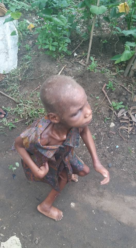Photos: Akwa Ibom-based optician rescues little girl with Cerebal palsy, left to die in a pit toilet by her mother