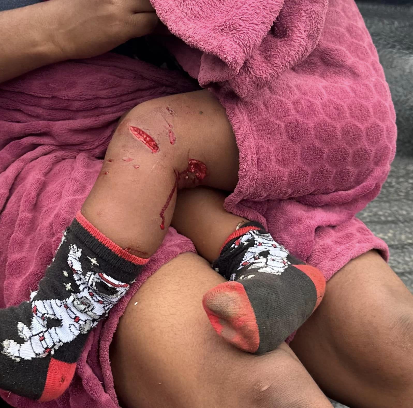 Two-year-old boy mauled by three dogs